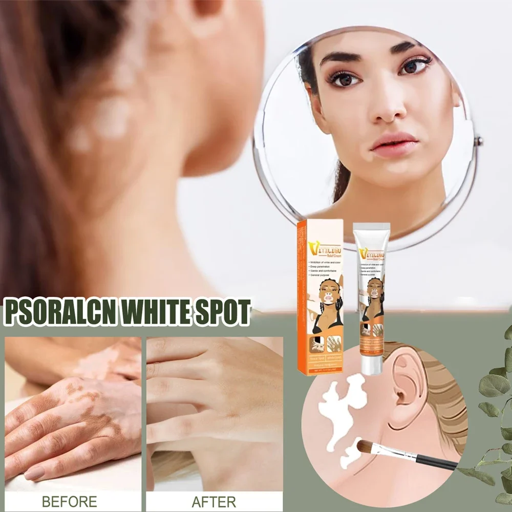 Natural Vitiligo Care Cream Reduces White Spots on Skin Vitiligo Cream for Spot Minimizing
Natural Vitiligo Care Cream Reduces White Spots on Skin Vitiligo Cream for Spot Minimizing