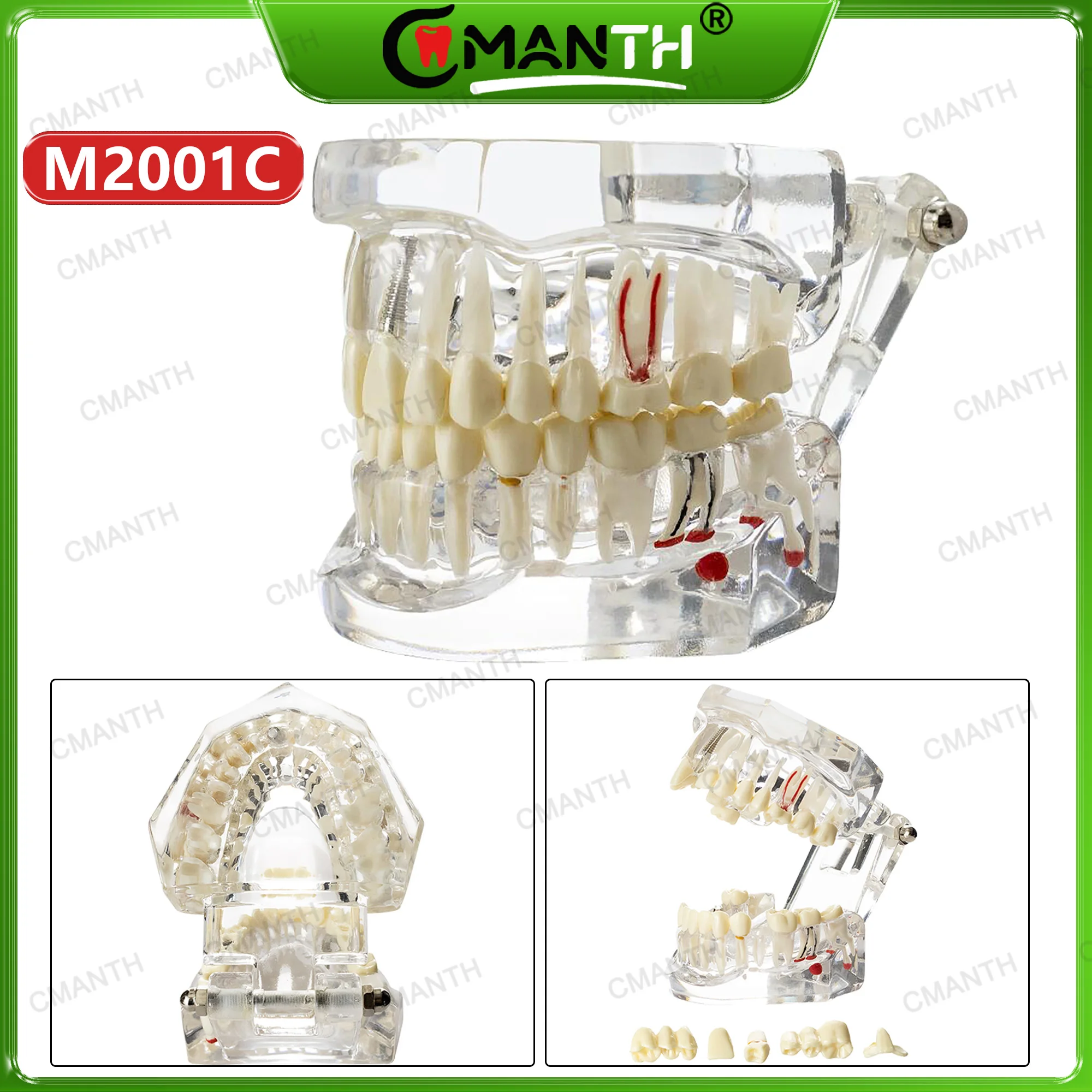 Dental Models Transparent Disease Tooth Model Typodont Implant With Removable Tooth Restoration Bridge Teaching Tooth Model
Dental Models Transparent Disease Tooth Model Typodont Implant With Removable Tooth Restoration Bridge Teaching Tooth Model