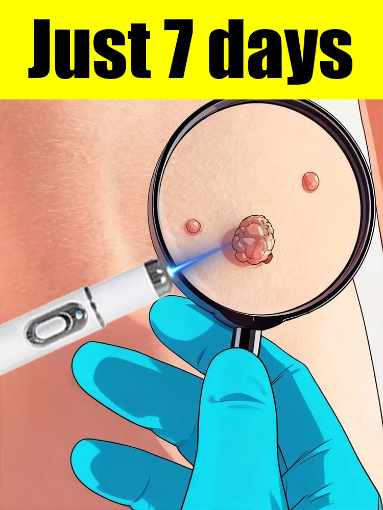 Laser pointer tools can smooth out and improve various types of warts from the root.
Laser pointer tools can smooth out and improve various types of warts from the root.