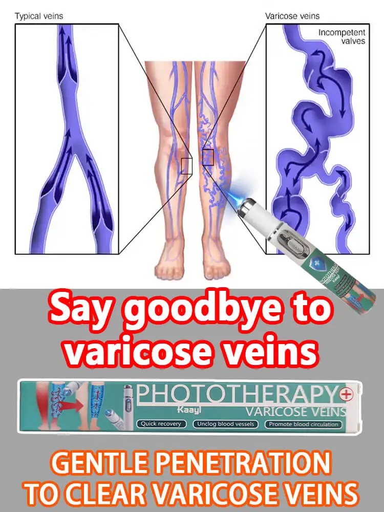 Reduces Spider Veins and Heaviness | for Anyone with Sedentary or Standing | Blue Light Laser
Reduces Spider Veins and Heaviness | for Anyone with Sedentary or Standing | Blue Light Laser