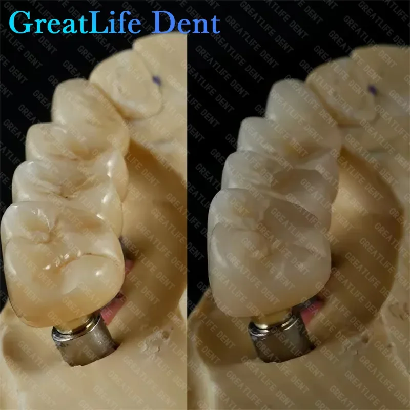 GreatLife Dent CAD CAM 98 мм 5D PRO Многослойный цирконий 10/12/14/16/18/20/22/25/30 мм Блоки Стоматологическая лаборатория CAD CAM Фрезерный материал
GreatLife Dent CAD CAM 98 мм 5D PRO Многослойный цирконий 10/12/14/16/18/20/22/25/30 мм Блоки Стоматологическая лаборатория CAD CAM Фрезерный материал