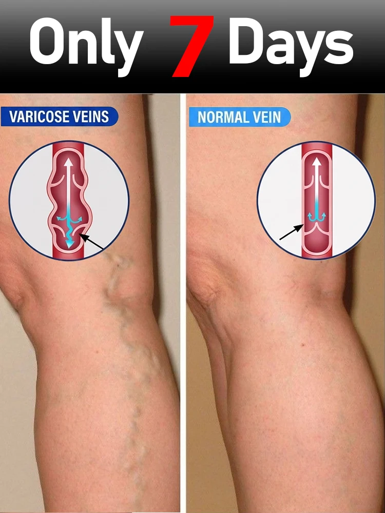 2-in-1Varicose Vein Lampshade Therapy Effective Improved Blood Circulation Relief Of Dilated Vasculitis In The Legs Phlebitis
2-in-1Varicose Vein Lampshade Therapy Effective Improved Blood Circulation Relief Of Dilated Vasculitis In The Legs Phlebitis