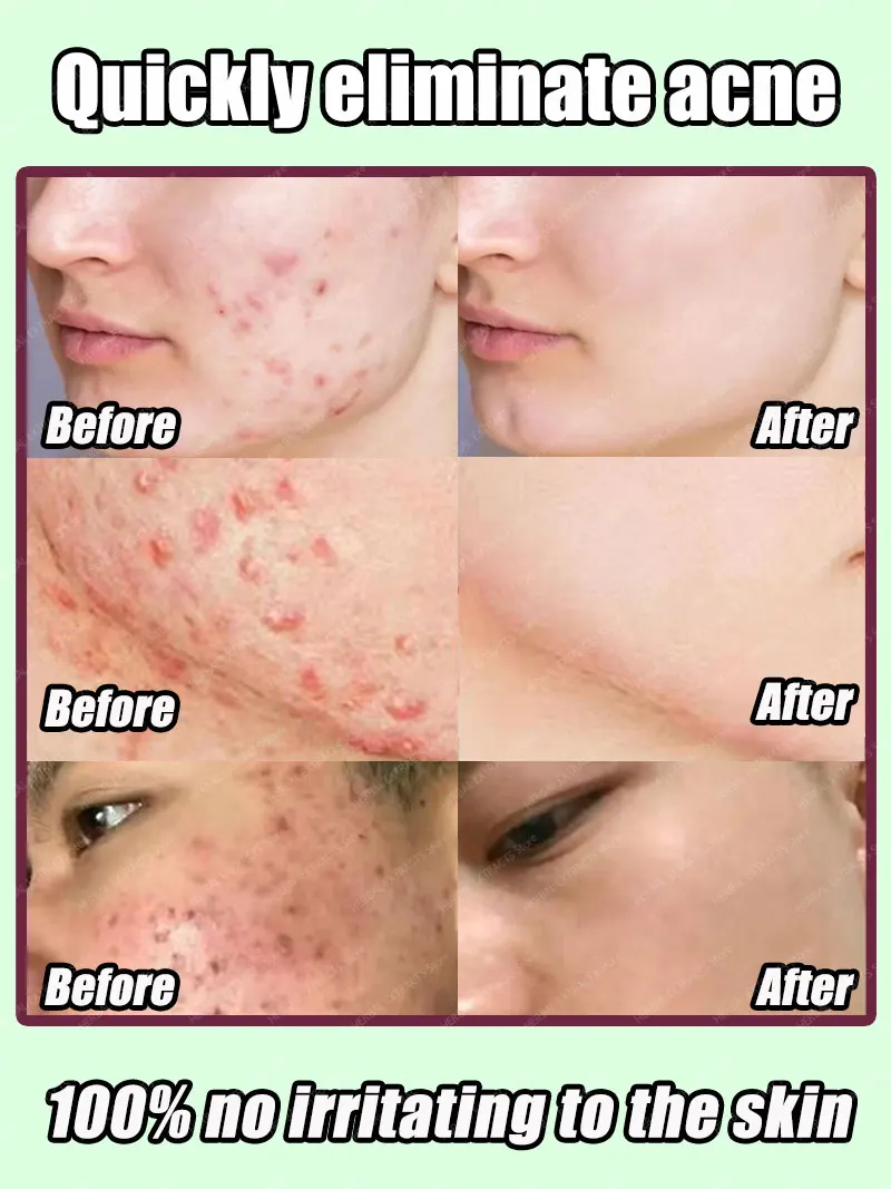 Acid Acne Removal Cream Anti-Acne Repair Redness Pimple Spots Deep Cleaning Pore Oil Control Moisturizing Skin Care
Acid Acne Removal Cream Anti-Acne Repair Redness Pimple Spots Deep Cleaning Pore Oil Control Moisturizing Skin Care
