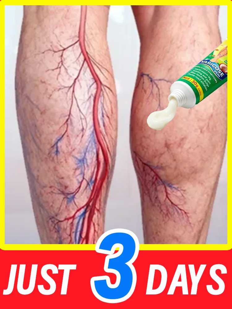 Relieves fatigue and ᴠᴀʀɪᴄᴏsᴇ ᴠᴇɪɴs, improves blood ᴄɪʀᴄᴜʟᴀᴛɪᴏɴ
Relieves fatigue and ᴠᴀʀɪᴄᴏsᴇ ᴠᴇɪɴs, improves blood ᴄɪʀᴄᴜʟᴀᴛɪᴏɴ