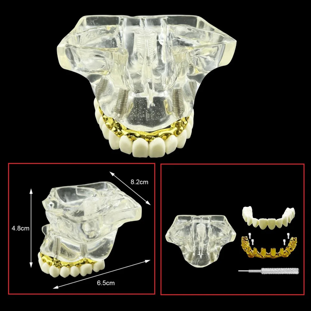 Dental Implant Model Maxillary Sinus With 4 Implants Gold Rod Mandibular With 6 Implants Silver Rod Removable Teeth Typodont
Dental Implant Model Maxillary Sinus With 4 Implants Gold Rod Mandibular With 6 Implants Silver Rod Removable Teeth Typodont