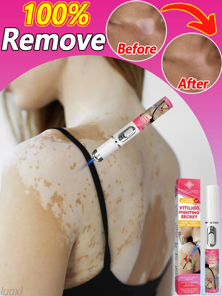 Новое лазерное удаление витилиго и выписки в 2025 году.
Новое лазерное удаление витилиго и выписки в 2025 году.