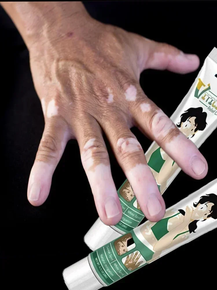 Экстракт Vitiligo травяная мазь, удаление шприца, удаление белых пятен, устранение кожи Vitiligo, крем для ухода
Экстракт Vitiligo травяная мазь, удаление шприца, удаление белых пятен, устранение кожи Vitiligo, крем для ухода