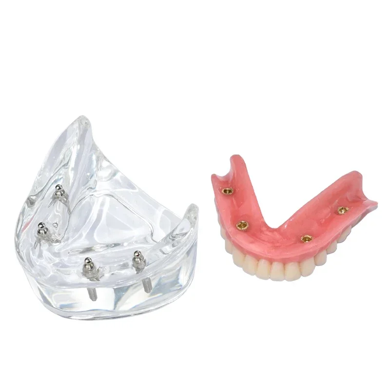 Dental Teeth Model 4 Implants Overdenture Removable Bridge Lower Mndibular Model M6003 Lab Demonstration Tools
Dental Teeth Model 4 Implants Overdenture Removable Bridge Lower Mndibular Model M6003 Lab Demonstration Tools