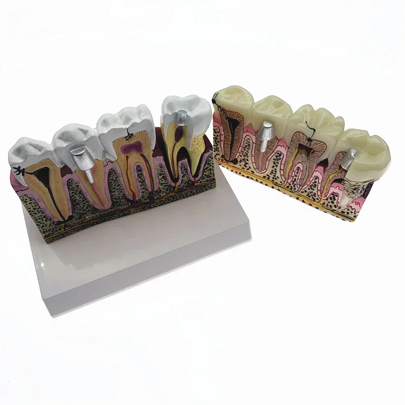Dentals Caries Anatomy Teeth Model Student Dentists Demonstration Communication Model
Dentals Caries Anatomy Teeth Model Student Dentists Demonstration Communication Model