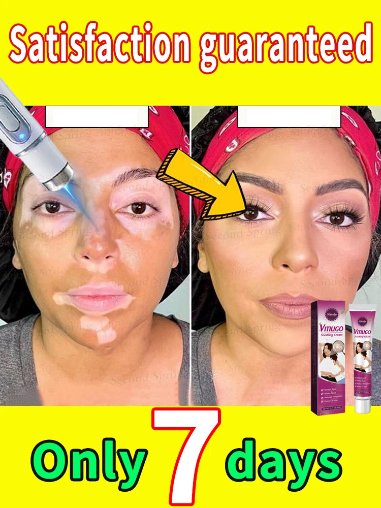 Effective in 7 days, the most popular product in 2025, no longer troubled by white spots, vitiligo patients
Effective in 7 days, the most popular product in 2025, no longer troubled by white spots, vitiligo patients