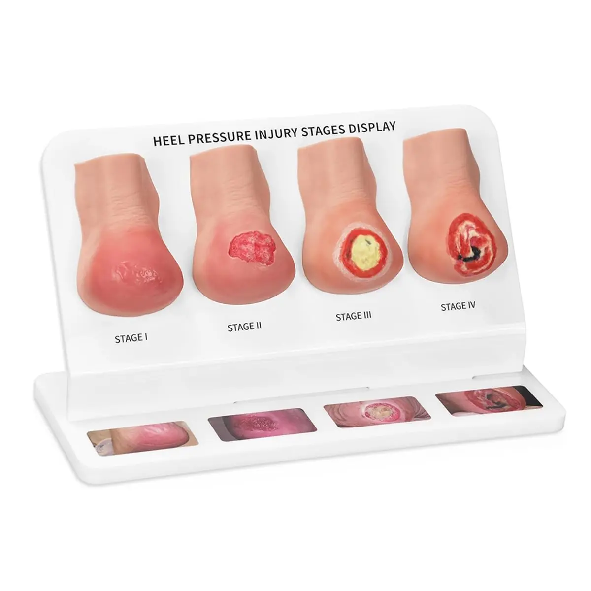 【TODAY-BUY】~@ Heel Pressure Injury Stages Model, Heel Ulcer Demonstration Model, Bed Sore Stages Education Tool for Training
【TODAY-BUY】~@ Heel Pressure Injury Stages Model, Heel Ulcer Demonstration Model, Bed Sore Stages Education Tool for Training