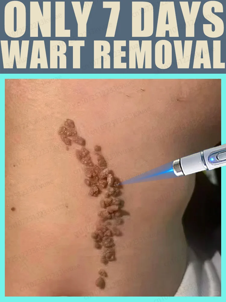Warts blue light tool, more discounts on sets
Warts blue light tool, more discounts on sets