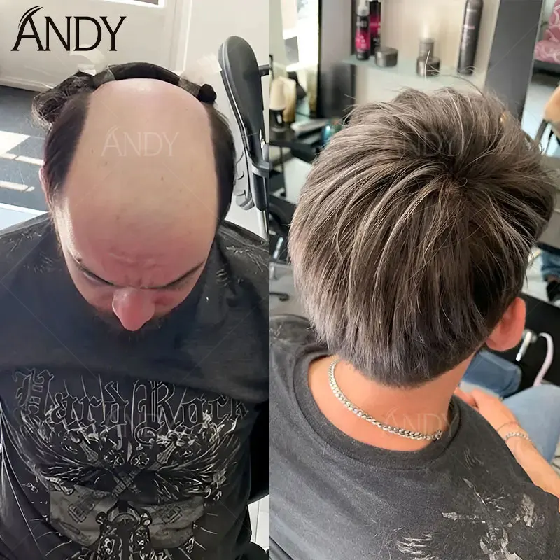 Male Capillary Prosthesis 0.12-0.14mm Injection Skin Toupee 100% Human Hair Natural Invisible Men Wig Comfortable Men's
Male Capillary Prosthesis 0.12-0.14mm Injection Skin Toupee 100% Human Hair Natural Invisible Men Wig Comfortable Men's