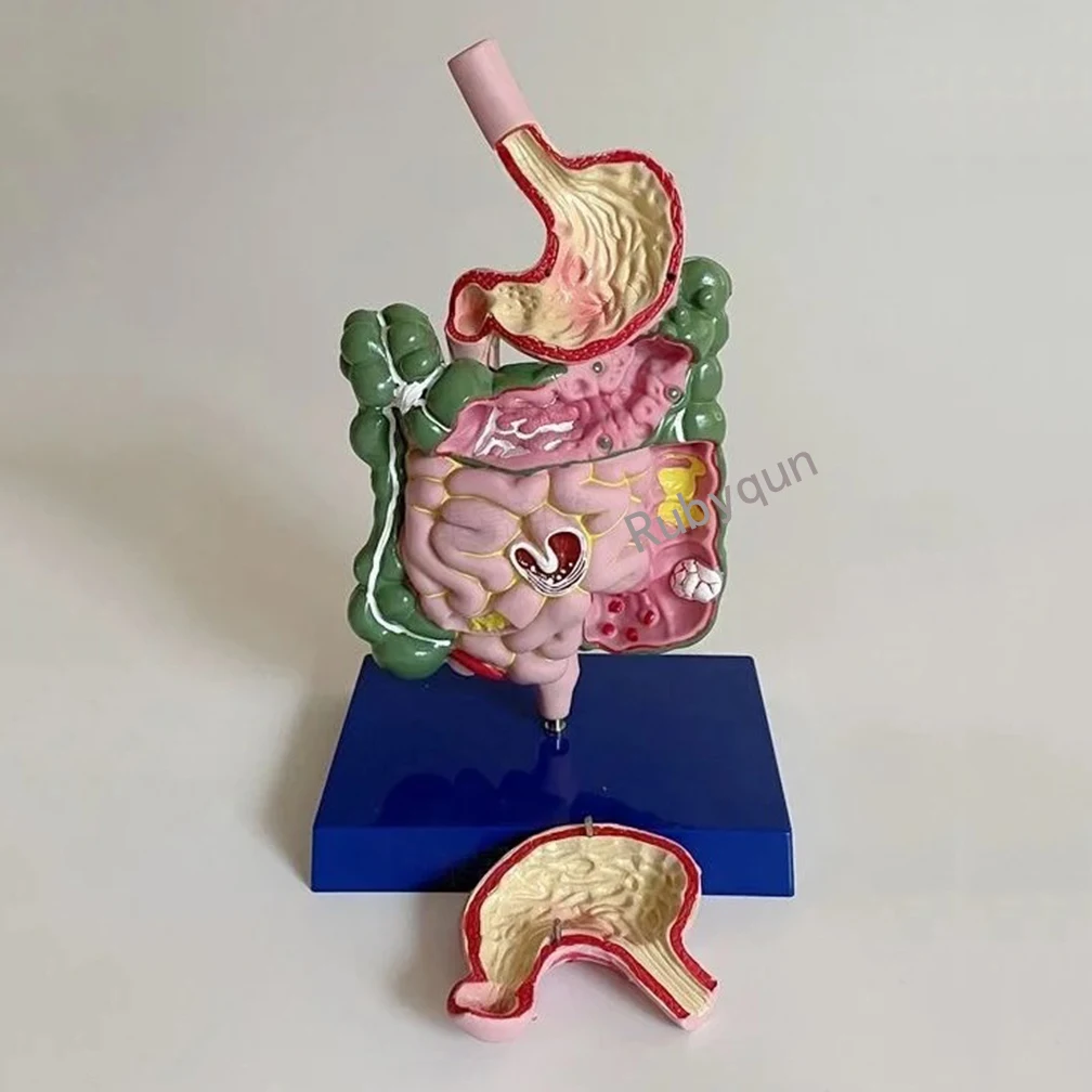 Модель пищеварительной системы человека, желудок, эзофаг, большая иле, мелкий кишечник, медицинская команда, патологический толстый геморрой
Модель пищеварительной системы человека, желудок, эзофаг, большая иле, мелкий кишечник, медицинская команда, патологический толстый геморрой