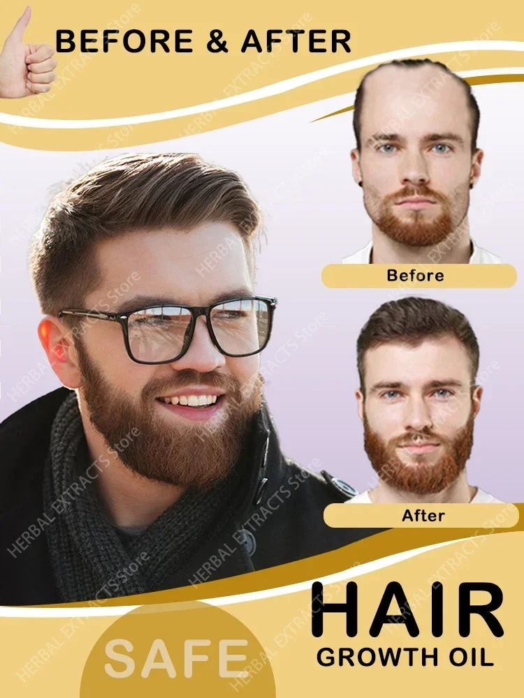 O óleo de crescimento capilar faz o cabelo crescer rapidamente, repara eficazmente a calvície e a queda de cabelo hereditária
O óleo de crescimento capilar faz o cabelo crescer rapidamente, repara eficazmente a calvície e a queda de cabelo hereditária