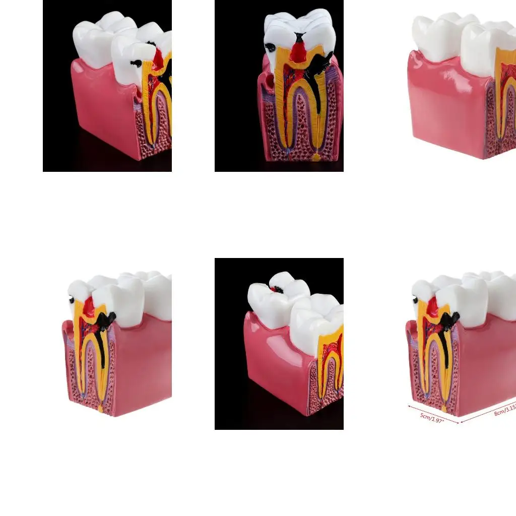 6 Caries Comparation Anatomy Teeth Model for Dental Anatomy Lab Tea
6 Caries Comparation Anatomy Teeth Model for Dental Anatomy Lab Tea