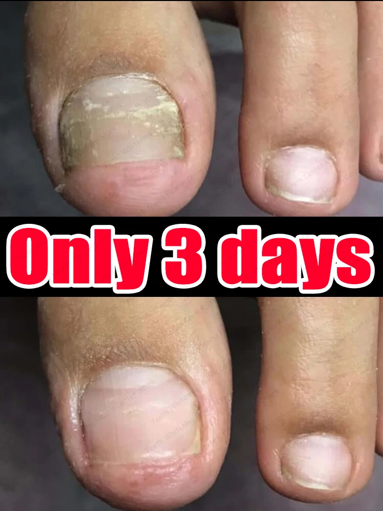 Лазерная лечебная ручка синего света для обработки кнопки онихомикозуна
Лазерная лечебная ручка синего света для обработки кнопки онихомикозуна