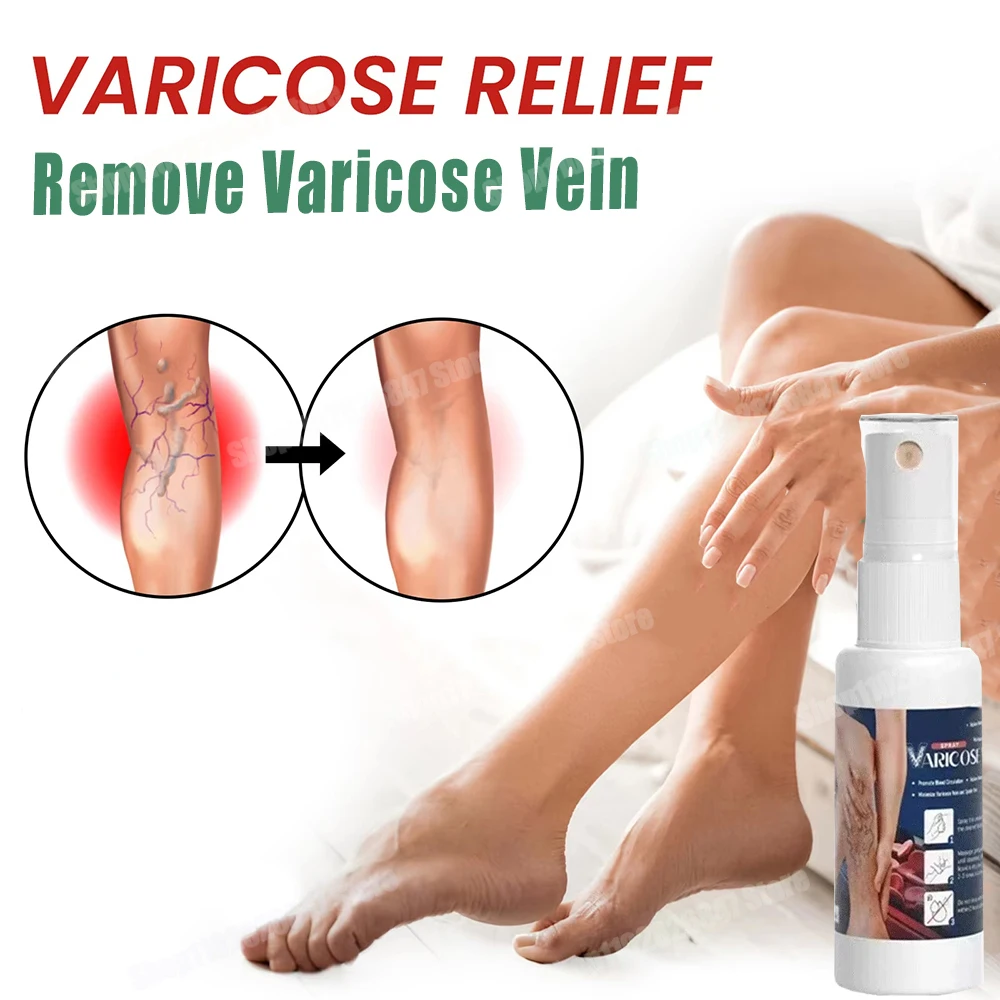 Effective Varicose Vein Spray Natural Herb Veins Soothing Essential Spray Vasculitis Phlebitis Spider Vein Earthworm Leg Cure
Effective Varicose Vein Spray Natural Herb Veins Soothing Essential Spray Vasculitis Phlebitis Spider Vein Earthworm Leg Cure