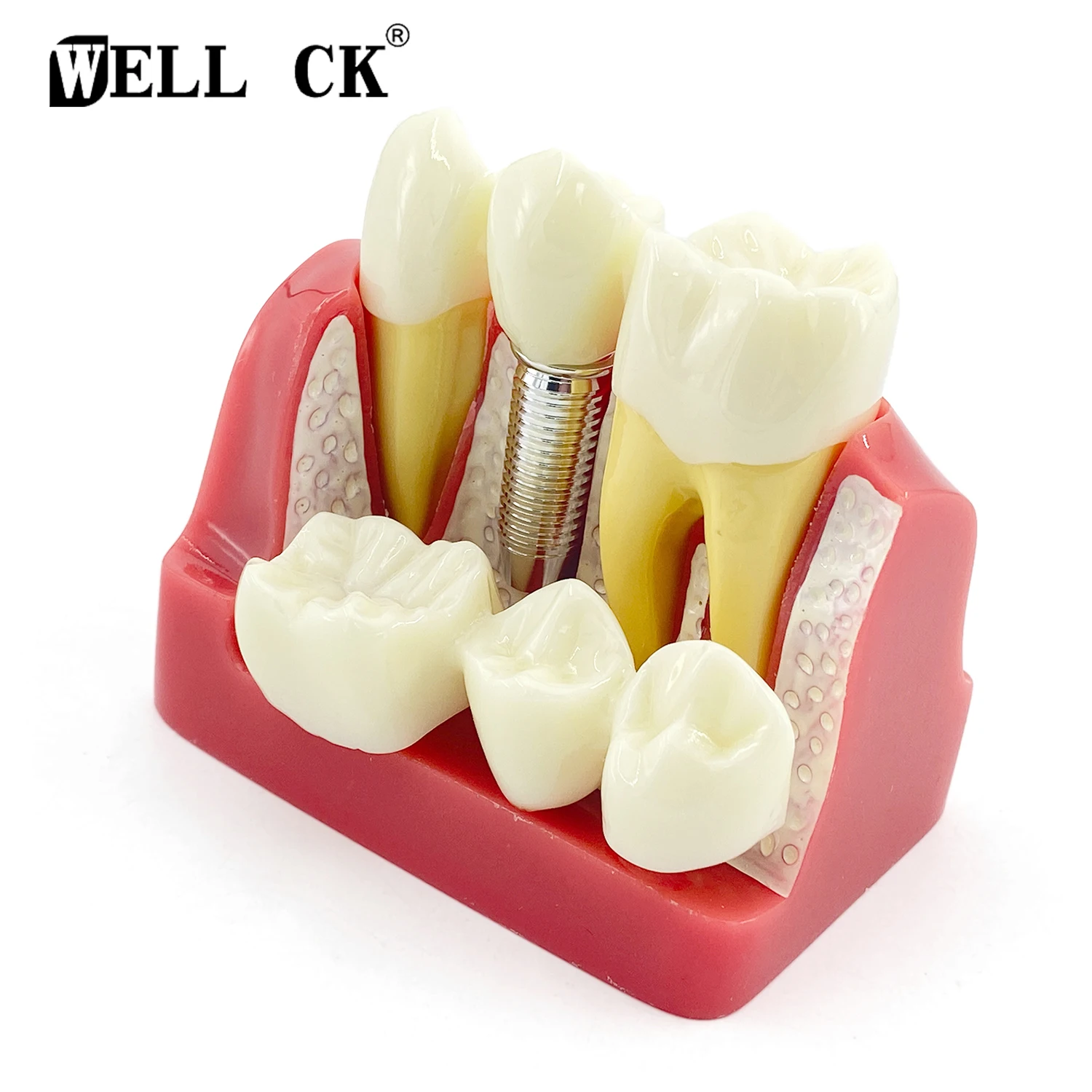 Dental Teaching Implant Analysis Crown Bridge Removable Model Dental Demonstration Teeth Model
Dental Teaching Implant Analysis Crown Bridge Removable Model Dental Demonstration Teeth Model