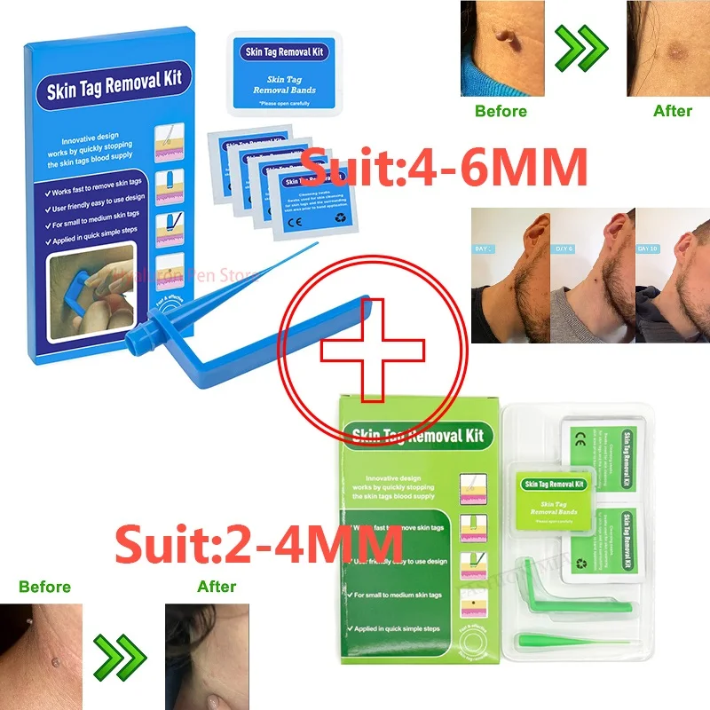 Medical Skin Tag Remover Kit Micro Band Papilloma Removal Patches Professional skin cleaning Tools For Spot Freckle Wart Removal
Medical Skin Tag Remover Kit Micro Band Papilloma Removal Patches Professional skin cleaning Tools For Spot Freckle Wart Removal