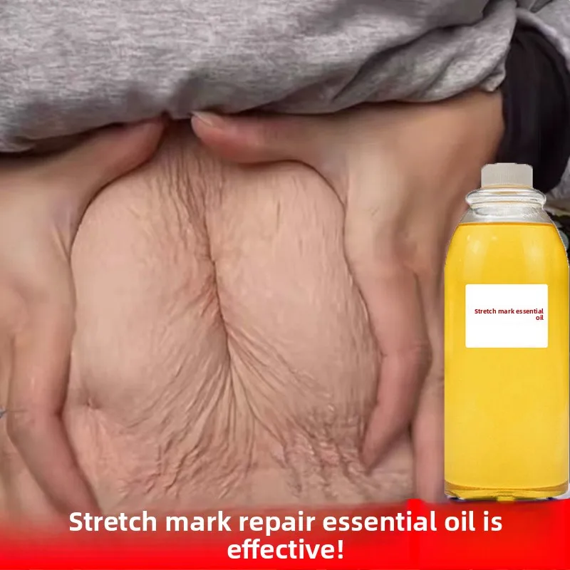 Pregnancy pattern removal, repair and firming oil, special beauty salon care for postpartum pregnant women
Pregnancy pattern removal, repair and firming oil, special beauty salon care for postpartum pregnant women