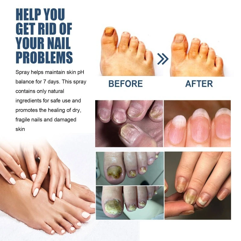 30ml Nail Care Spray Gentle Hand Foot Care Nail Fungus Treatment Repair Spray Refreshing Moisturizing Bright Liquid Health Care
30ml Nail Care Spray Gentle Hand Foot Care Nail Fungus Treatment Repair Spray Refreshing Moisturizing Bright Liquid Health Care