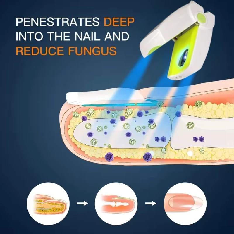 Лазер грибка ногтей 905 нм и 470 нм — дисплей времени и USB-перезаряжаемое устройство для обработки
Лазер грибка ногтей 905 нм и 470 нм — дисплей времени и USB-перезаряжаемое устройство для обработки