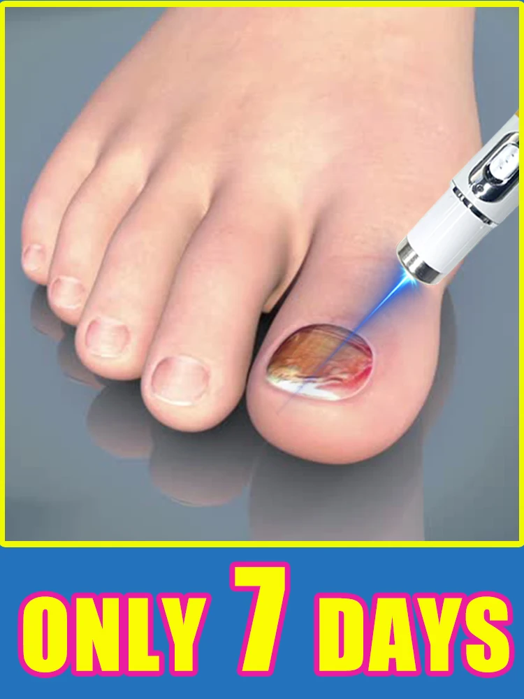 Профессиональный уход, точное устранение грибка, а конец утолщения и пожелтения.
Профессиональный уход, точное устранение грибка, а конец утолщения и пожелтения.