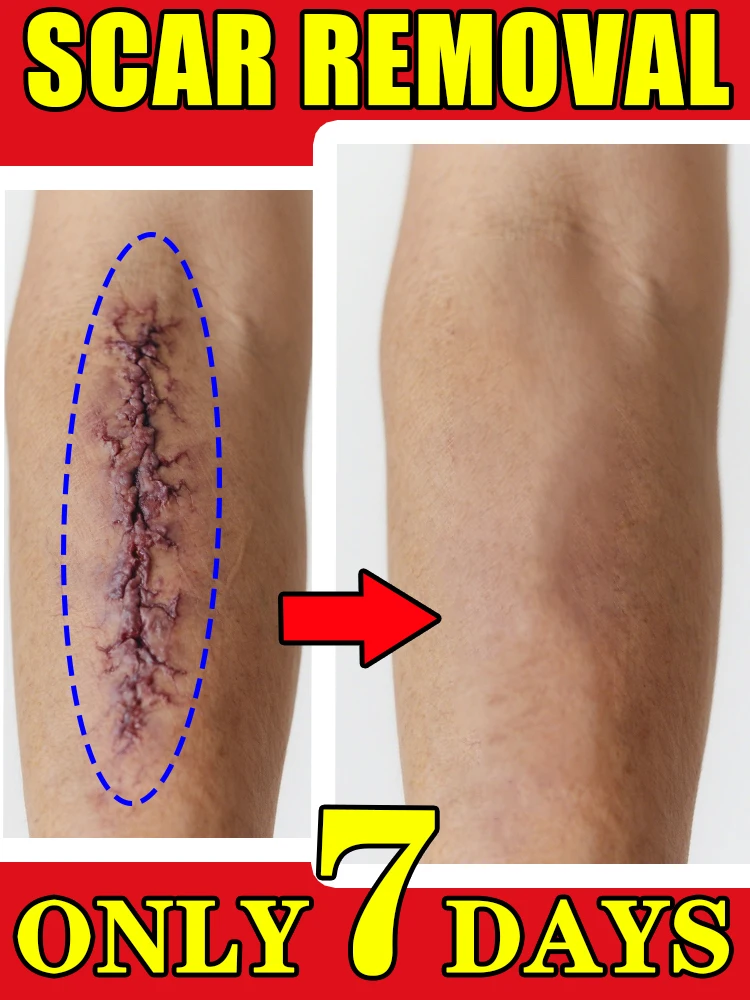 Apply it at home, the scars will become ˡⁱᵍʰᵗᵉʳ ʷⁱᵗʰᵒᵘᵗ ᵃᶠᶠᵉᶜᵗⁱⁿᵍ ʸᵒᵘʳ ˡⁱᶠᵉ
Apply it at home, the scars will become ˡⁱᵍʰᵗᵉʳ ʷⁱᵗʰᵒᵘᵗ ᵃᶠᶠᵉᶜᵗⁱⁿᵍ ʸᵒᵘʳ ˡⁱᶠᵉ