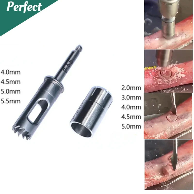 Dental Implant Bone Harvesting Ring Drill with Stop Ring Depth Controllable Oral Hollow Bone Harvesting Ring Drill
Dental Implant Bone Harvesting Ring Drill with Stop Ring Depth Controllable Oral Hollow Bone Harvesting Ring Drill