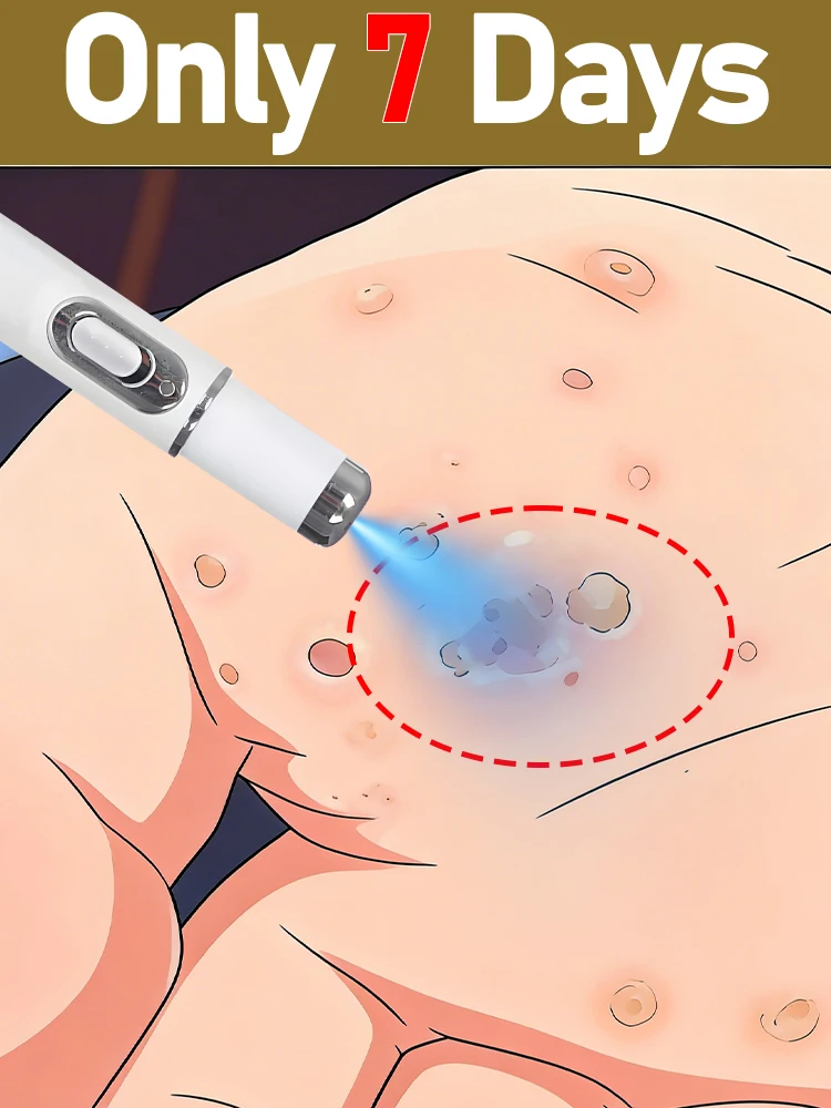 Ручка для удаления бородавок, средство для удаления кожных наростов, безболезненное удаление бородавок, инструмент для ухода за кожей и красоты.
Ручка для удаления бородавок, средство для удаления кожных наростов, безболезненное удаление бородавок, инструмент для ухода за кожей и красоты.