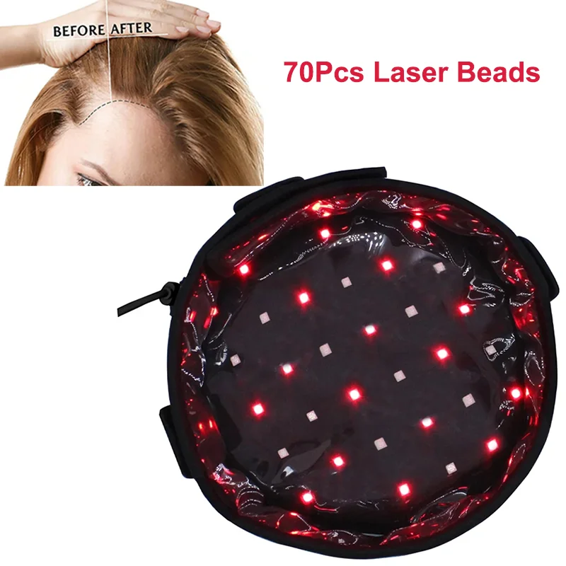Hair Regrowth Cap Red Light Therapy Devices 660nm & 880nm Near Infrared for Hair Loss Helmet70Pcs Laser Beads Red Light Therapy
Hair Regrowth Cap Red Light Therapy Devices 660nm & 880nm Near Infrared for Hair Loss Helmet70Pcs Laser Beads Red Light Therapy