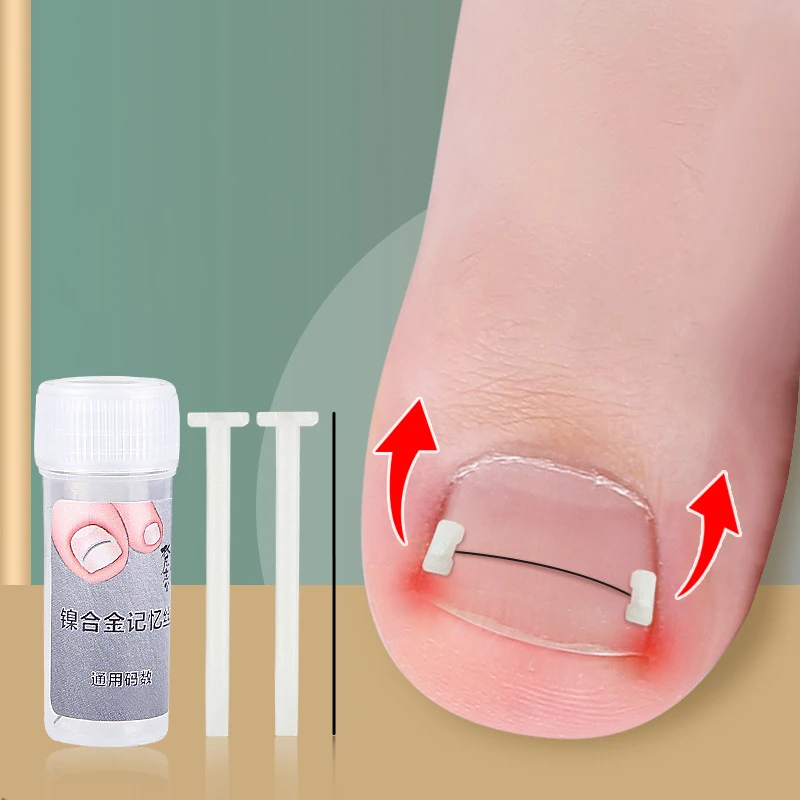 Ingrown Toenail Corrector Tools Pedicure Recover Embed Toe Nail Treatment Professional Ingrown Toenail Correction Foot Care
Ingrown Toenail Corrector Tools Pedicure Recover Embed Toe Nail Treatment Professional Ingrown Toenail Correction Foot Care
