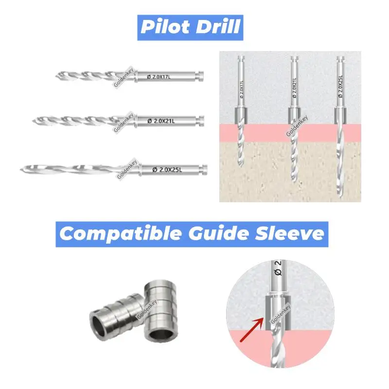 φ2.0 Dental Pilot Drill Guide Sleeve Digital Guided Scanner Sleeves Pioneer DSG
φ2.0 Dental Pilot Drill Guide Sleeve Digital Guided Scanner Sleeves Pioneer DSG