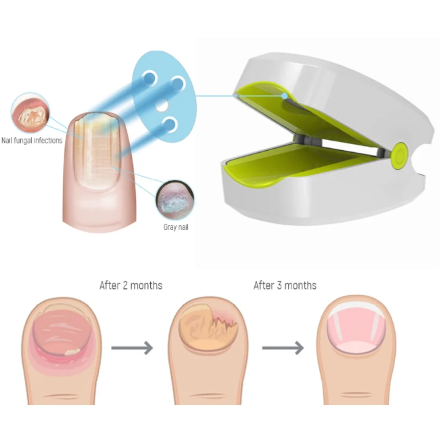 Efficient 905nm Laser Nail Therapy Device, Professional Fungus Removal for Healthy Toenails, Safe Home Use Instrument
Efficient 905nm Laser Nail Therapy Device, Professional Fungus Removal for Healthy Toenails, Safe Home Use Instrument