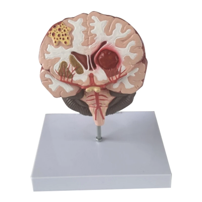 Top-Human Brain Disease Model - Brain Pathology Brainstem Hemorrhage Teaching Model - Human Brain Anatomy Model
Top-Human Brain Disease Model - Brain Pathology Brainstem Hemorrhage Teaching Model - Human Brain Anatomy Model