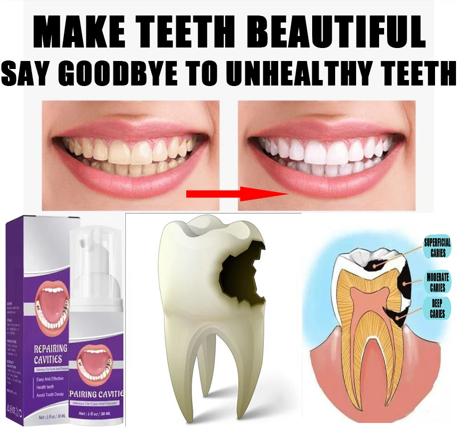 Quick Repair of Cavities Caries Removal of Plaque Stains Decay Whitening Yellowing Repair Teeth Teeth Whitening
Quick Repair of Cavities Caries Removal of Plaque Stains Decay Whitening Yellowing Repair Teeth Teeth Whitening