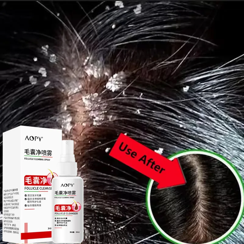 Hair Scalp Treatment Spray Remove Dandruff Itching Oil Control Anti Loss Scalp Cleaning Repair Serum Beauty Hair Care Products
Hair Scalp Treatment Spray Remove Dandruff Itching Oil Control Anti Loss Scalp Cleaning Repair Serum Beauty Hair Care Products