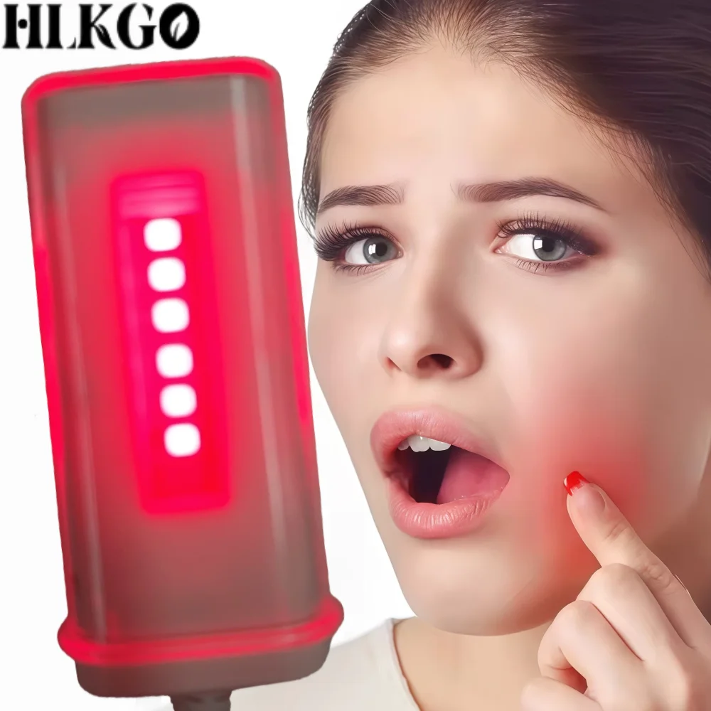 Clinical Oral Ulcer Treatment Laser 650nm LLLT Red Light Therapy Device for Sore Throat and Mouth
Clinical Oral Ulcer Treatment Laser 650nm LLLT Red Light Therapy Device for Sore Throat and Mouth