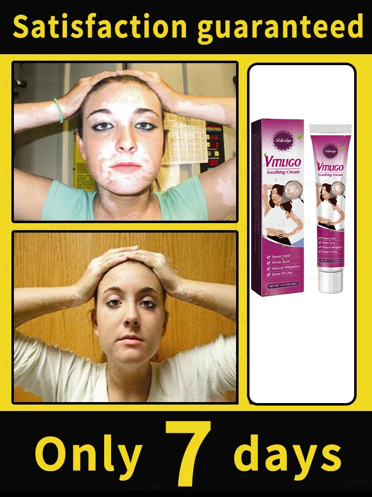 Effective in 7 days, the most popular product in 2025, no longer troubled by white spots, vitiligo patients
Effective in 7 days, the most popular product in 2025, no longer troubled by white spots, vitiligo patients