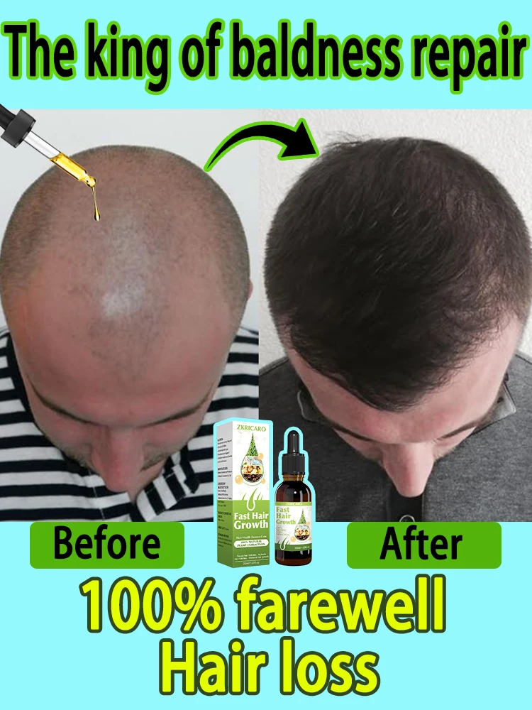 The king of hair growth essences, repairs all kinds of hair loss problems, 100% repeat customers
The king of hair growth essences, repairs all kinds of hair loss problems, 100% repeat customers