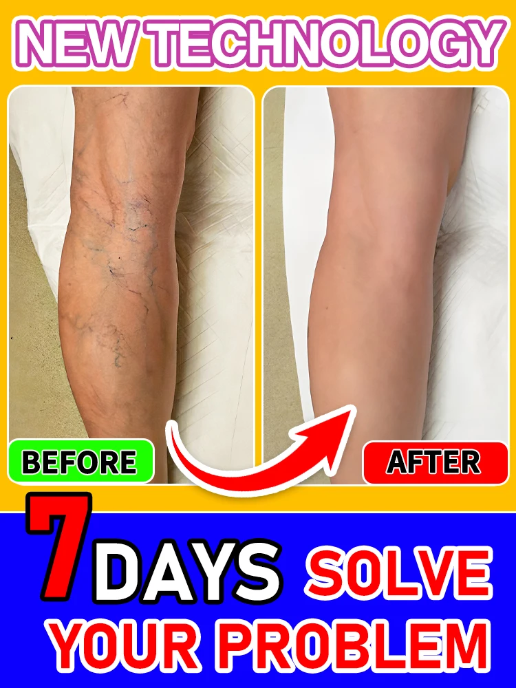 Сочетание задач, таких как ноги-паука, варикозное расширение вен, флебита и т. д. Улучшите кровеносные сосуды 
Сочетание задач, таких как ноги-паука, варикозное расширение вен, флебита и т. д. Улучшите кровеносные сосуды