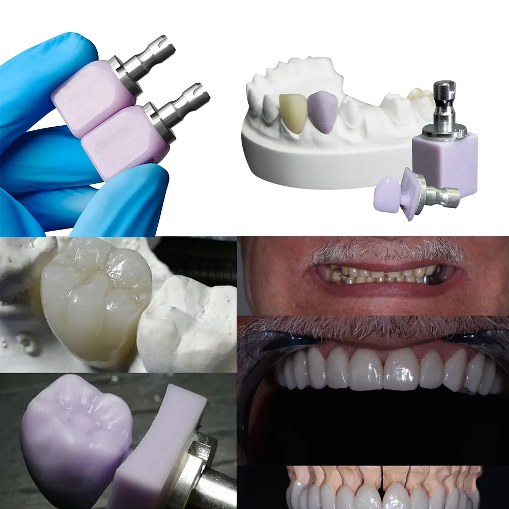 C14 Glass Ceramic Blocks HT/LT Lithium Disilicate Glass Ceramic for CAD CAM Sirona Cerec Veneer Dentist Material 5pcs/Box
C14 Glass Ceramic Blocks HT/LT Lithium Disilicate Glass Ceramic for CAD CAM Sirona Cerec Veneer Dentist Material 5pcs/Box