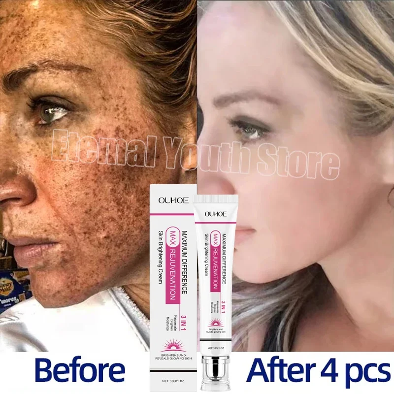 Powerful Spot-removing Whiten Cream Brighten Skin Fast Eliminates Melanin Pigmentation Melasma Dark Spots Korean Skin Care
Powerful Spot-removing Whiten Cream Brighten Skin Fast Eliminates Melanin Pigmentation Melasma Dark Spots Korean Skin Care