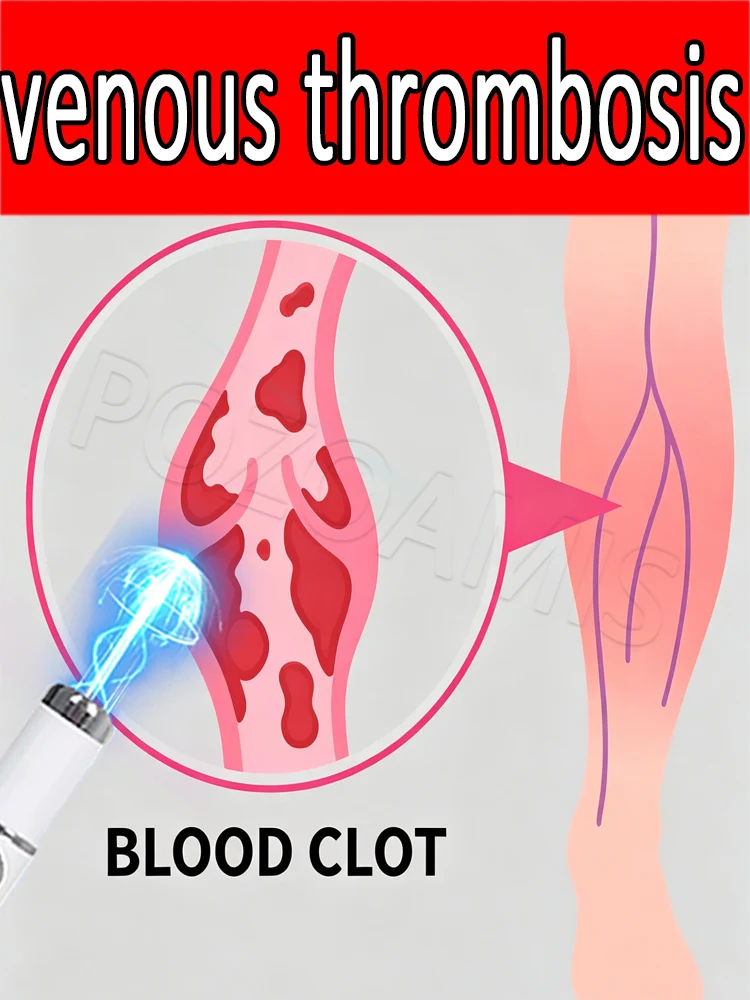 Varicose vein compʟɪᴄᴀᴛɪᴏɴs ᴄᴀɴ ʙᴇ ᴛʀᴇᴀᴛᴇᴅ ᴡɪᴛʜ
Varicose vein compʟɪᴄᴀᴛɪᴏɴs ᴄᴀɴ ʙᴇ ᴛʀᴇᴀᴛᴇᴅ ᴡɪᴛʜ