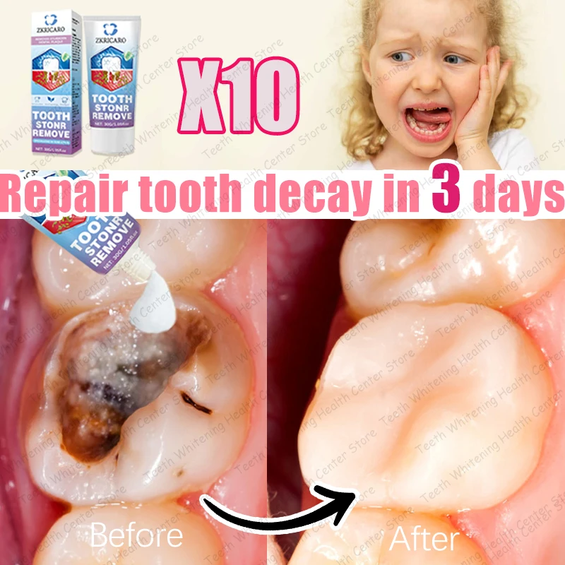 Contains probiotics to repair tooth decay and clean teeth.
Contains probiotics to repair tooth decay and clean teeth.