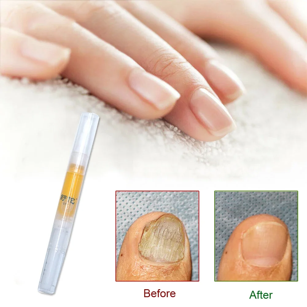 Nail Repair Liquid Pen Nail Fungus Treatment Serum Nails Toe Cream Anti Removal Gel Repair Foot Fungal Liquid Infection 3ML
Nail Repair Liquid Pen Nail Fungus Treatment Serum Nails Toe Cream Anti Removal Gel Repair Foot Fungal Liquid Infection 3ML