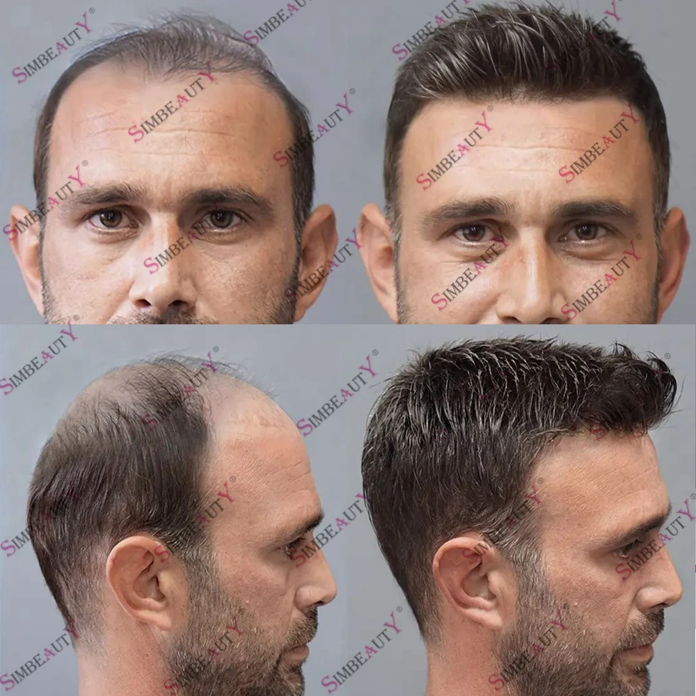 Super Durable Strong Poly Skin Human Hair Men's Toupee Indian Hair Affordable 0.1mm Full PU Base Capillary Prosthesis Hairpiece
Super Durable Strong Poly Skin Human Hair Men's Toupee Indian Hair Affordable 0.1mm Full PU Base Capillary Prosthesis Hairpiece