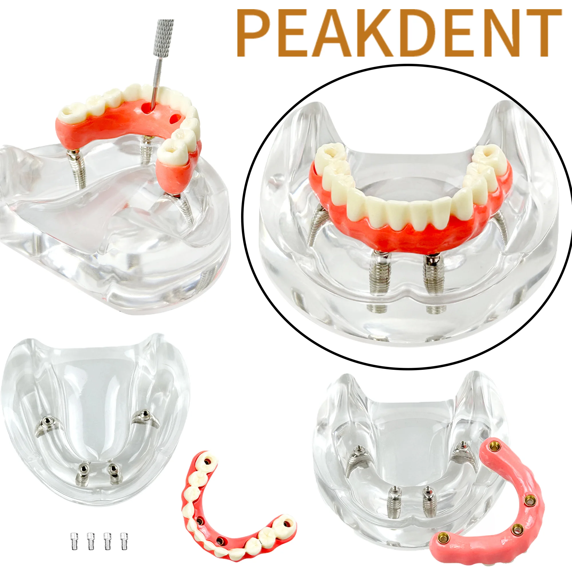Dental Implant Model with Implant Overdenture Inferior Lower Tooth Dentist Student Education Typodont Implant Demo Model
Dental Implant Model with Implant Overdenture Inferior Lower Tooth Dentist Student Education Typodont Implant Demo Model