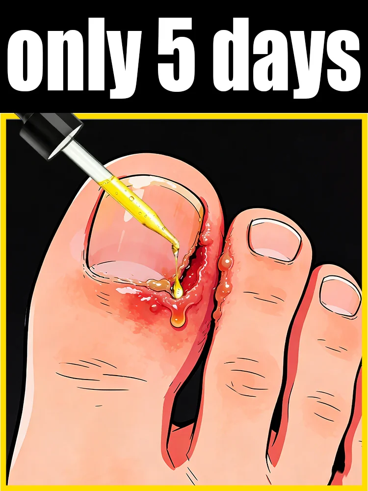 Eʟɪᴍɪɴᴀᴛᴇ ғᴜɴɢᴀʟ ɴᴀɪʟs Rapid penetration, restoring nails to their natural shine. Say goodbye to fungal nails
Eʟɪᴍɪɴᴀᴛᴇ ғᴜɴɢᴀʟ ɴᴀɪʟs Rapid penetration, restoring nails to their natural shine. Say goodbye to fungal nails